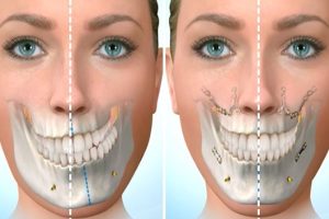 Lee más sobre el artículo Cirugía Ortognática: Transformando la Armonía Facial y Funcional